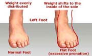 Flat foot